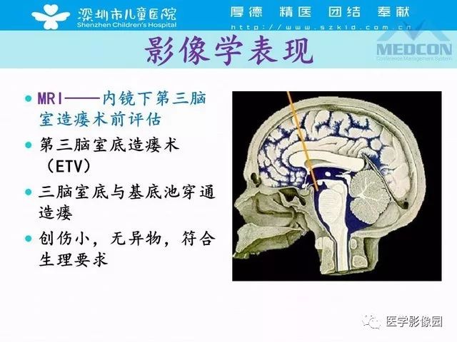 影像PPT - 【PPT】脑积水定义、分类新进展和影像诊断-47