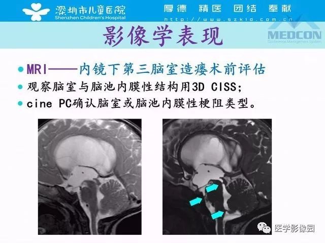 影像PPT - 【PPT】脑积水定义、分类新进展和影像诊断-49