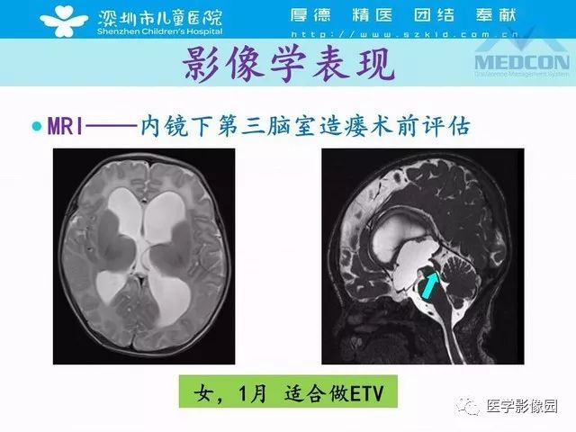 影像PPT - 【PPT】脑积水定义、分类新进展和影像诊断-50