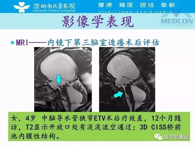 影像PPT - 【PPT】脑积水定义、分类新进展和影像诊断-53