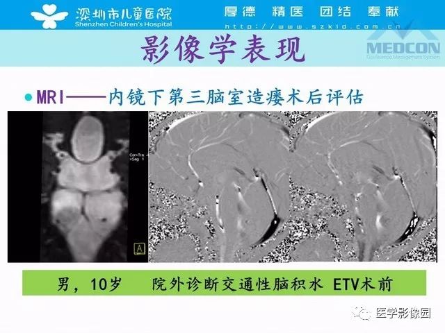 影像PPT - 【PPT】脑积水定义、分类新进展和影像诊断-54