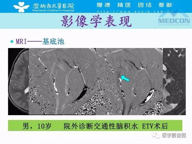 影像PPT - 【PPT】脑积水定义、分类新进展和影像诊断-55
