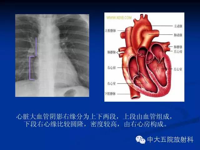 影像PPT - 【PPT】胸部正位片验证PICC-15