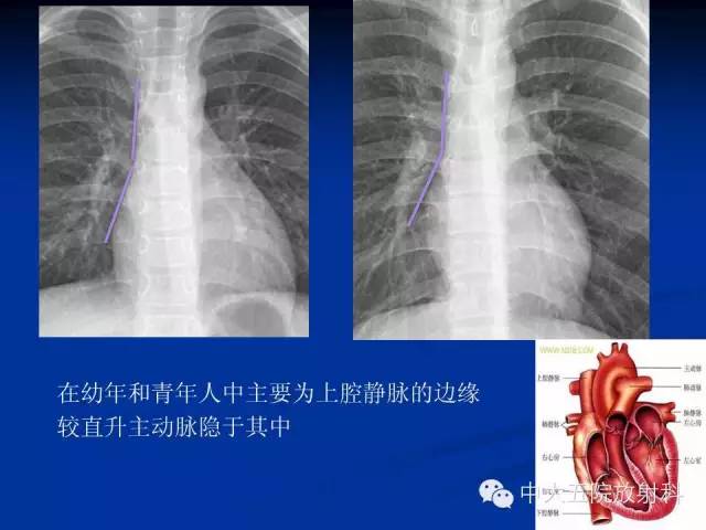 影像PPT - 【PPT】胸部正位片验证PICC-16