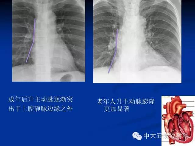 影像PPT - 【PPT】胸部正位片验证PICC-17