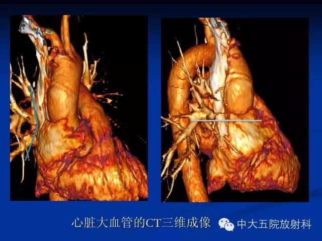 影像PPT - 【PPT】胸部正位片验证PICC-18