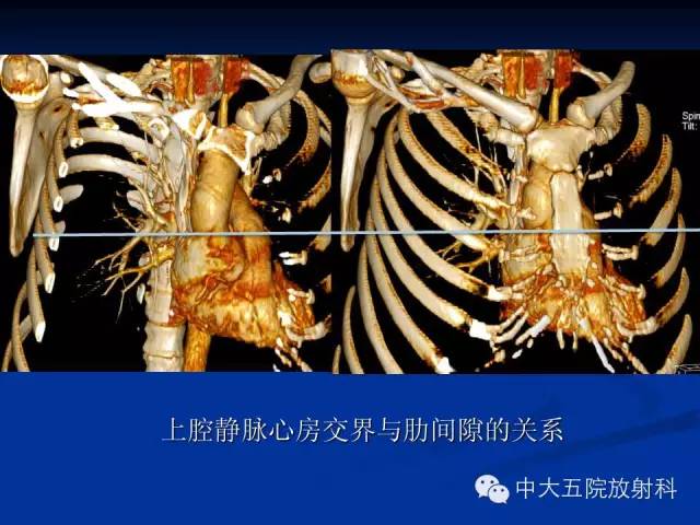 影像PPT - 【PPT】胸部正位片验证PICC-19