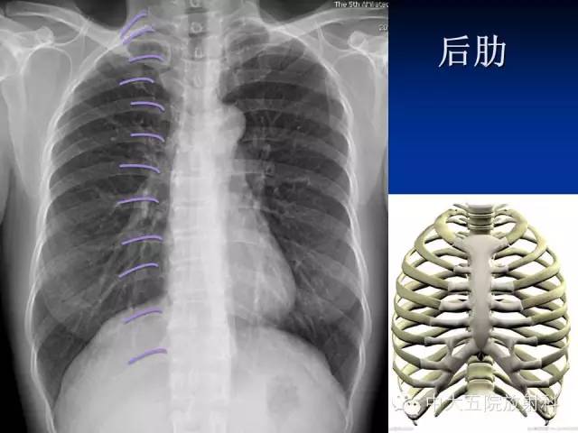 影像PPT - 【PPT】胸部正位片验证PICC-21