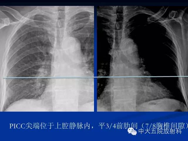 影像PPT - 【PPT】胸部正位片验证PICC-24