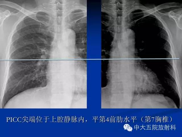 影像PPT - 【PPT】胸部正位片验证PICC-25