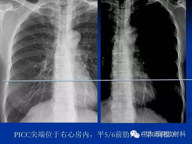 影像PPT - 【PPT】胸部正位片验证PICC-26