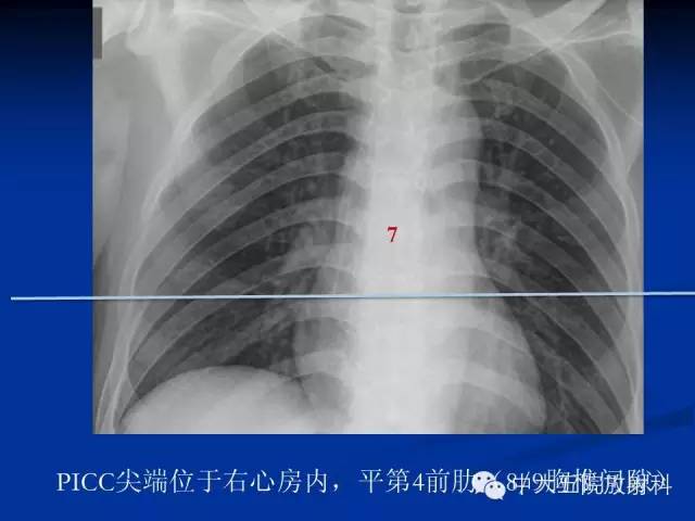 影像PPT - 【PPT】胸部正位片验证PICC-28