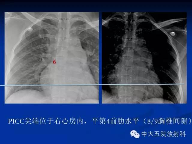 影像PPT - 【PPT】胸部正位片验证PICC-29