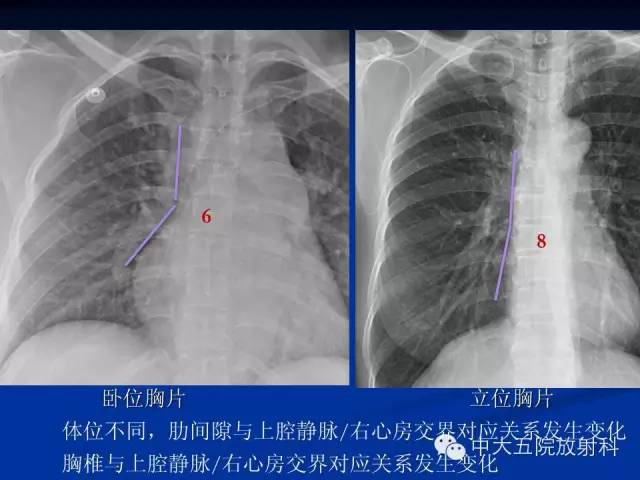 影像PPT - 【PPT】胸部正位片验证PICC-30