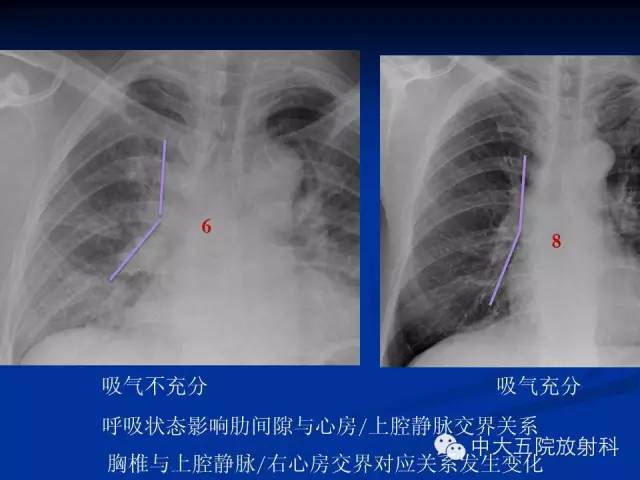 影像PPT - 【PPT】胸部正位片验证PICC-31