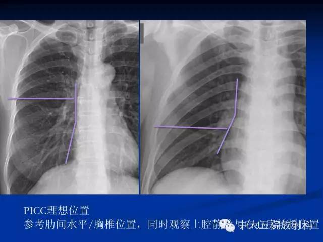 影像PPT - 【PPT】胸部正位片验证PICC-33