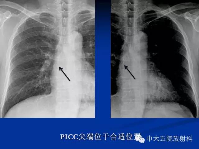影像PPT - 【PPT】胸部正位片验证PICC-36