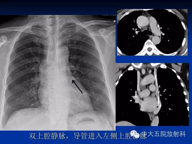 影像PPT - 【PPT】胸部正位片验证PICC-37
