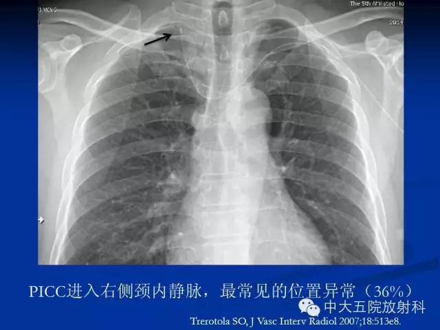 影像PPT - 【PPT】胸部正位片验证PICC-38