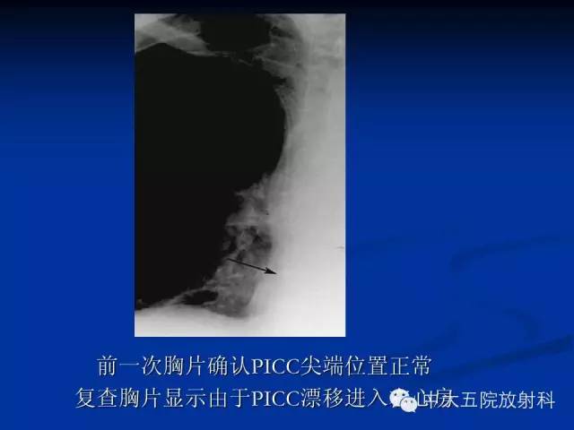 影像PPT - 【PPT】胸部正位片验证PICC-40