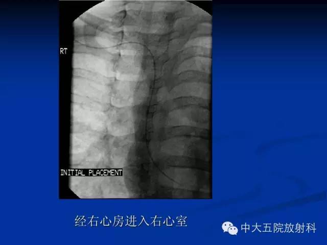 影像PPT - 【PPT】胸部正位片验证PICC-41