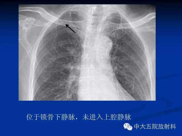 影像PPT - 【PPT】胸部正位片验证PICC-42