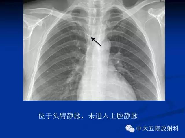 影像PPT - 【PPT】胸部正位片验证PICC-43