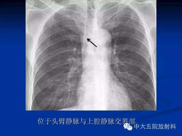 影像PPT - 【PPT】胸部正位片验证PICC-44