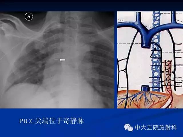 影像PPT - 【PPT】胸部正位片验证PICC-45