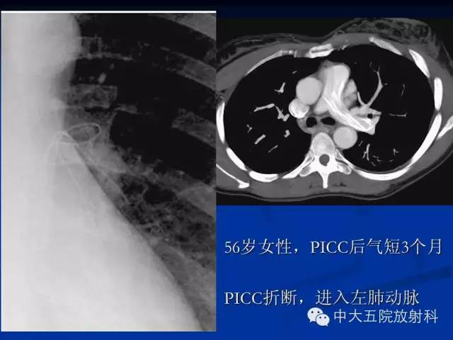 影像PPT - 【PPT】胸部正位片验证PICC-46