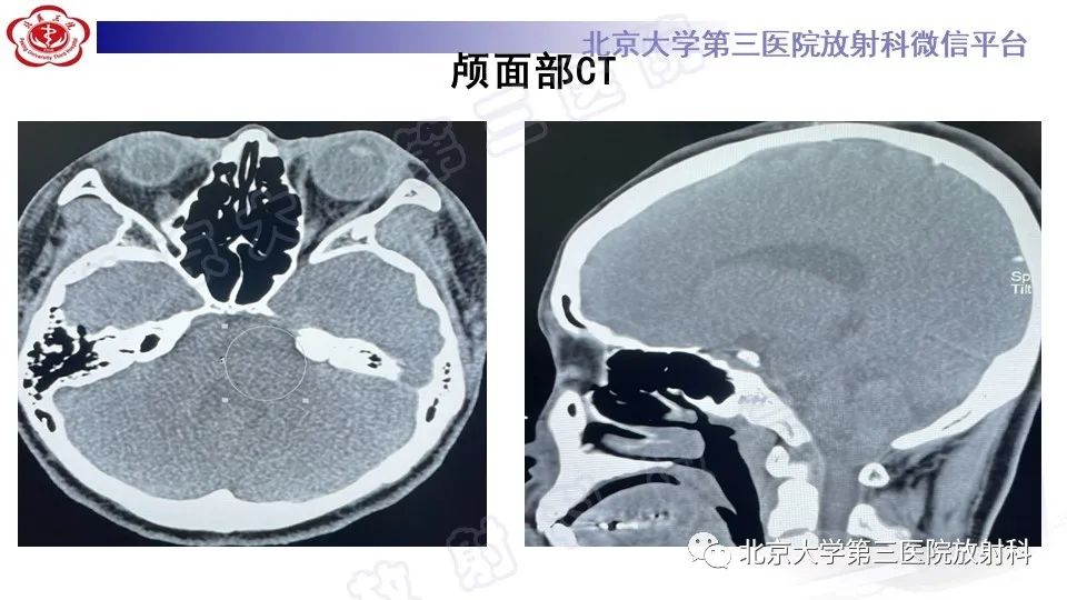 影像PPT - 【PPT】脑干胶质瘤-3
