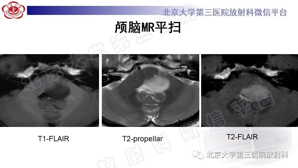 影像PPT - 【PPT】脑干胶质瘤-4