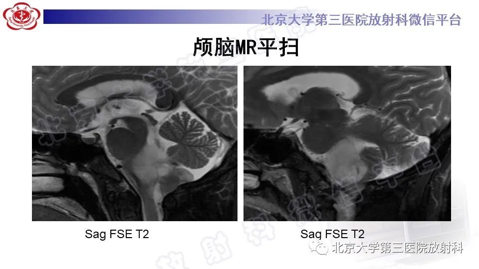 影像PPT - 【PPT】脑干胶质瘤-5