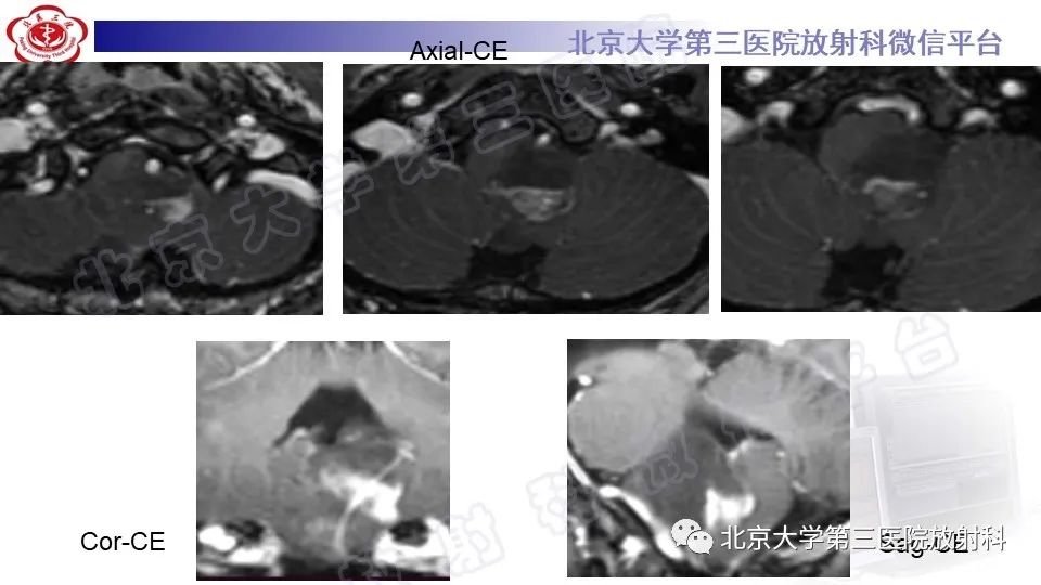 影像PPT - 【PPT】脑干胶质瘤-6