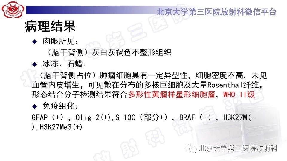 影像PPT - 【PPT】脑干胶质瘤-9