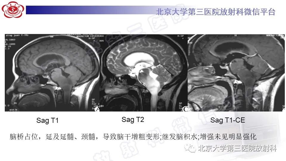 影像PPT - 【PPT】脑干胶质瘤-15