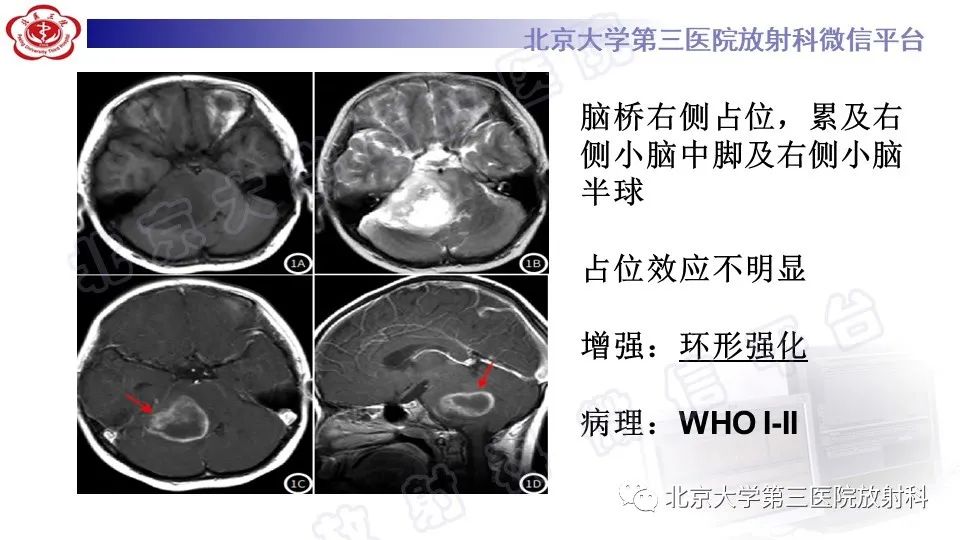影像PPT - 【PPT】脑干胶质瘤-16