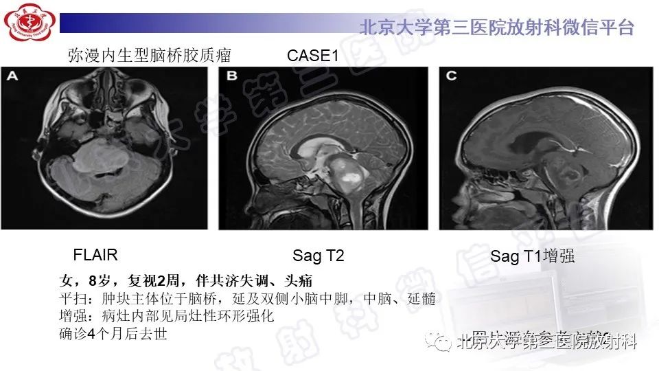 影像PPT - 【PPT】脑干胶质瘤-19