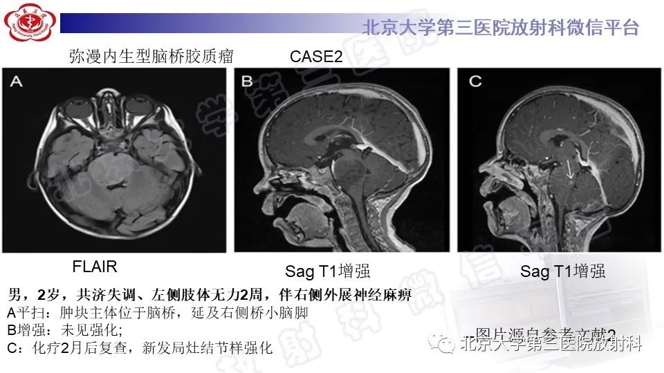 影像PPT - 【PPT】脑干胶质瘤-20