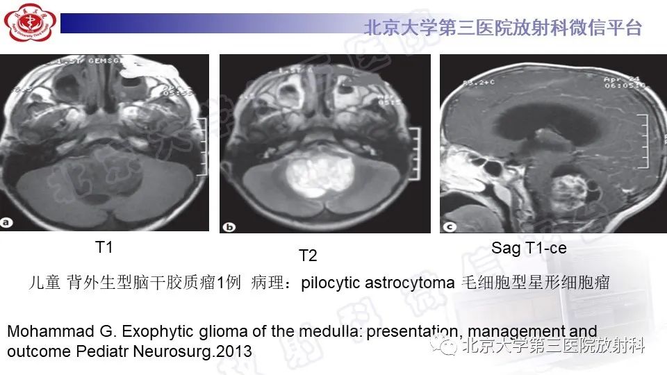 影像PPT - 【PPT】脑干胶质瘤-23