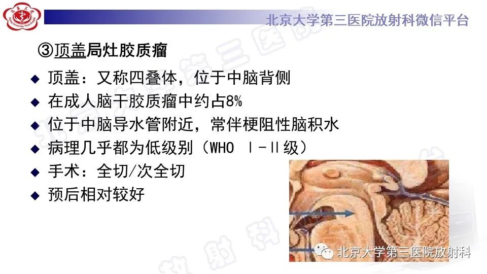 影像PPT - 【PPT】脑干胶质瘤-21