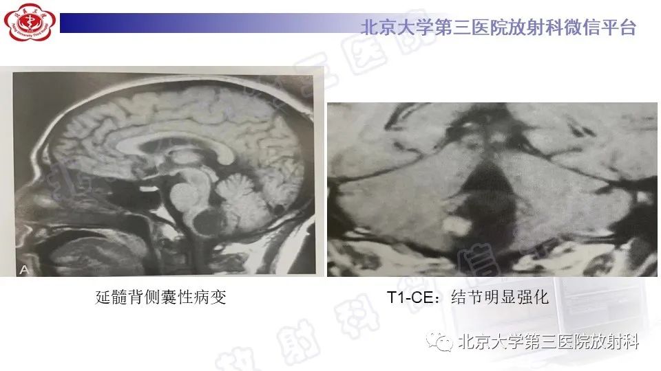 影像PPT - 【PPT】脑干胶质瘤-26
