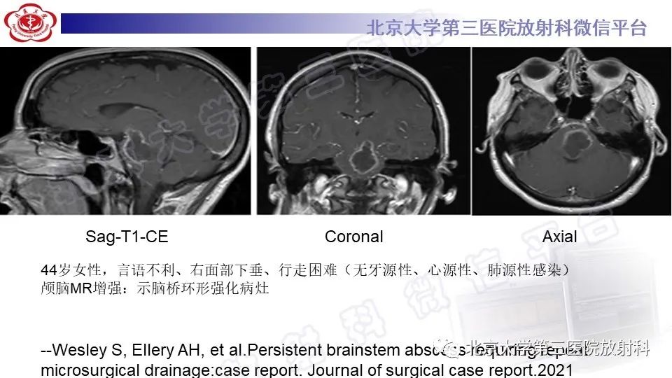 影像PPT - 【PPT】脑干胶质瘤-28