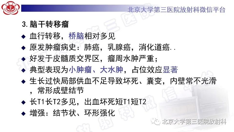 影像PPT - 【PPT】脑干胶质瘤-29