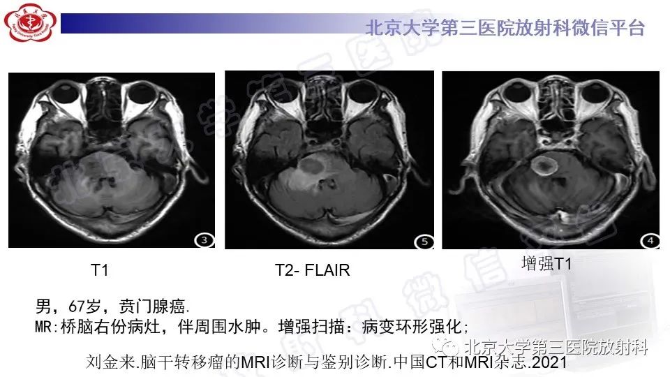 影像PPT - 【PPT】脑干胶质瘤-30