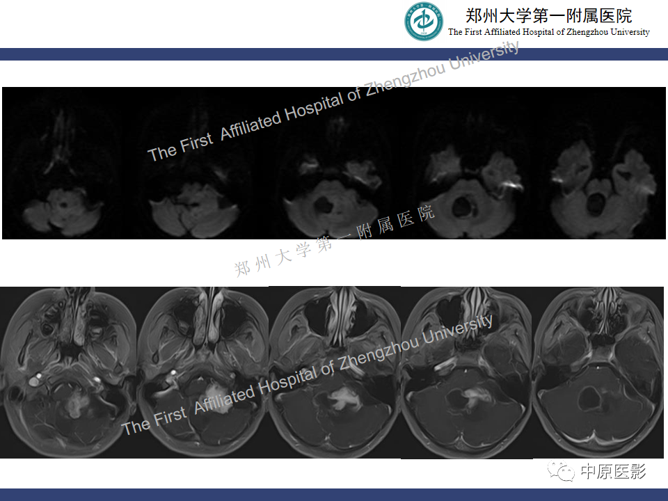 影像PPT - 【病例】小脑多形性黄色瘤性星形细胞瘤1例MR影像-5
