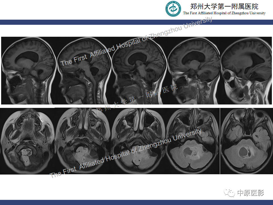 影像PPT - 【病例】小脑多形性黄色瘤性星形细胞瘤1例MR影像-4