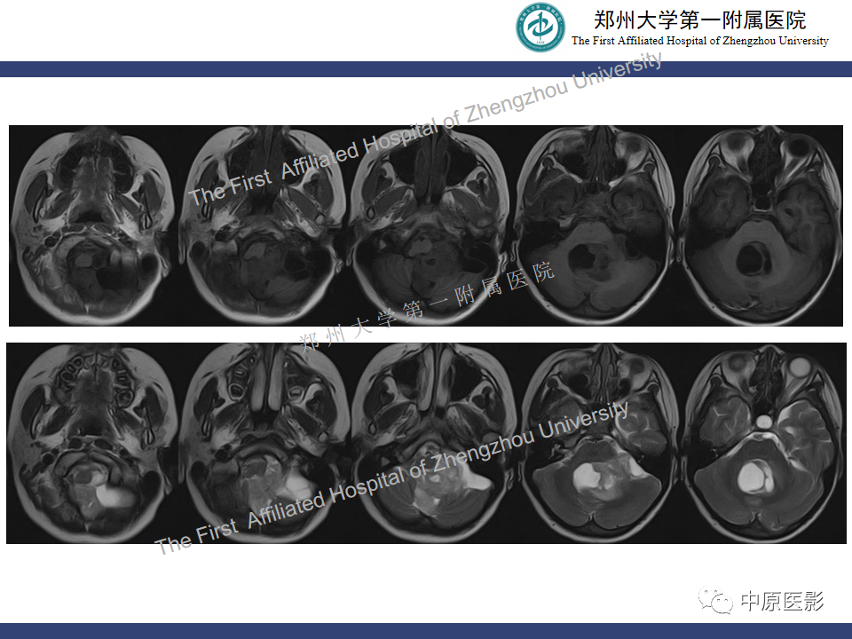 影像PPT - 【病例】小脑多形性黄色瘤性星形细胞瘤1例MR影像-3