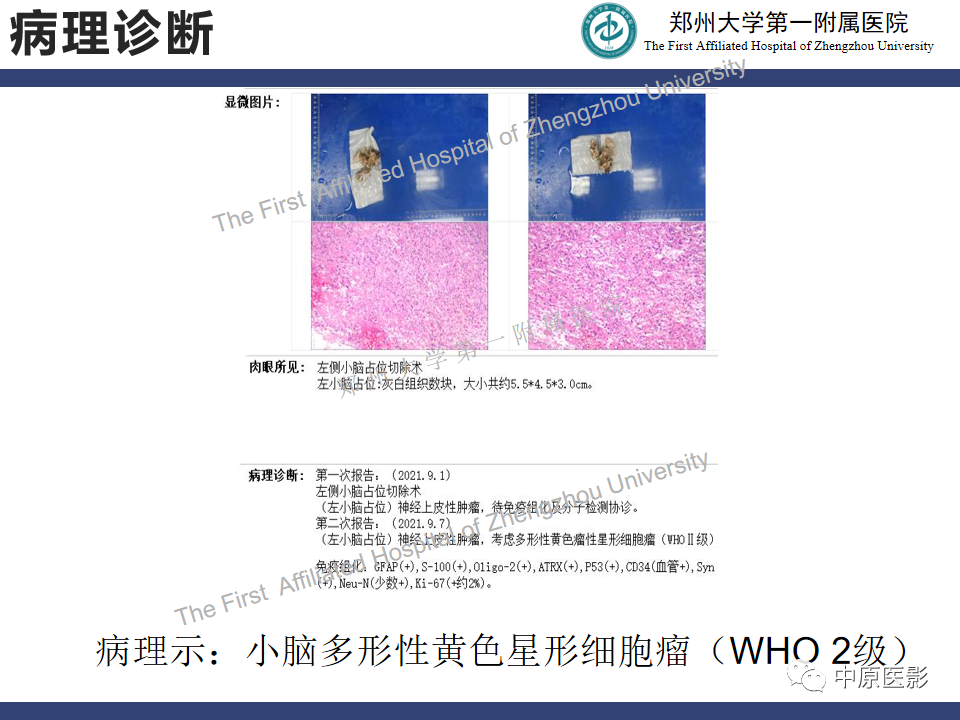 影像PPT - 【病例】小脑多形性黄色瘤性星形细胞瘤1例MR影像-9