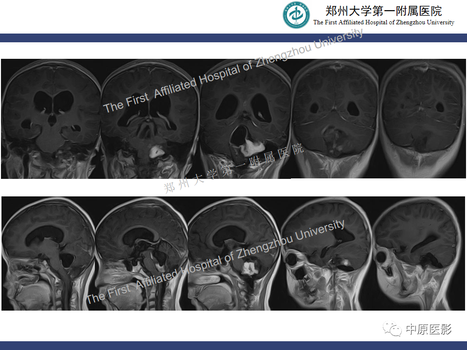 影像PPT - 【病例】小脑多形性黄色瘤性星形细胞瘤1例MR影像-6